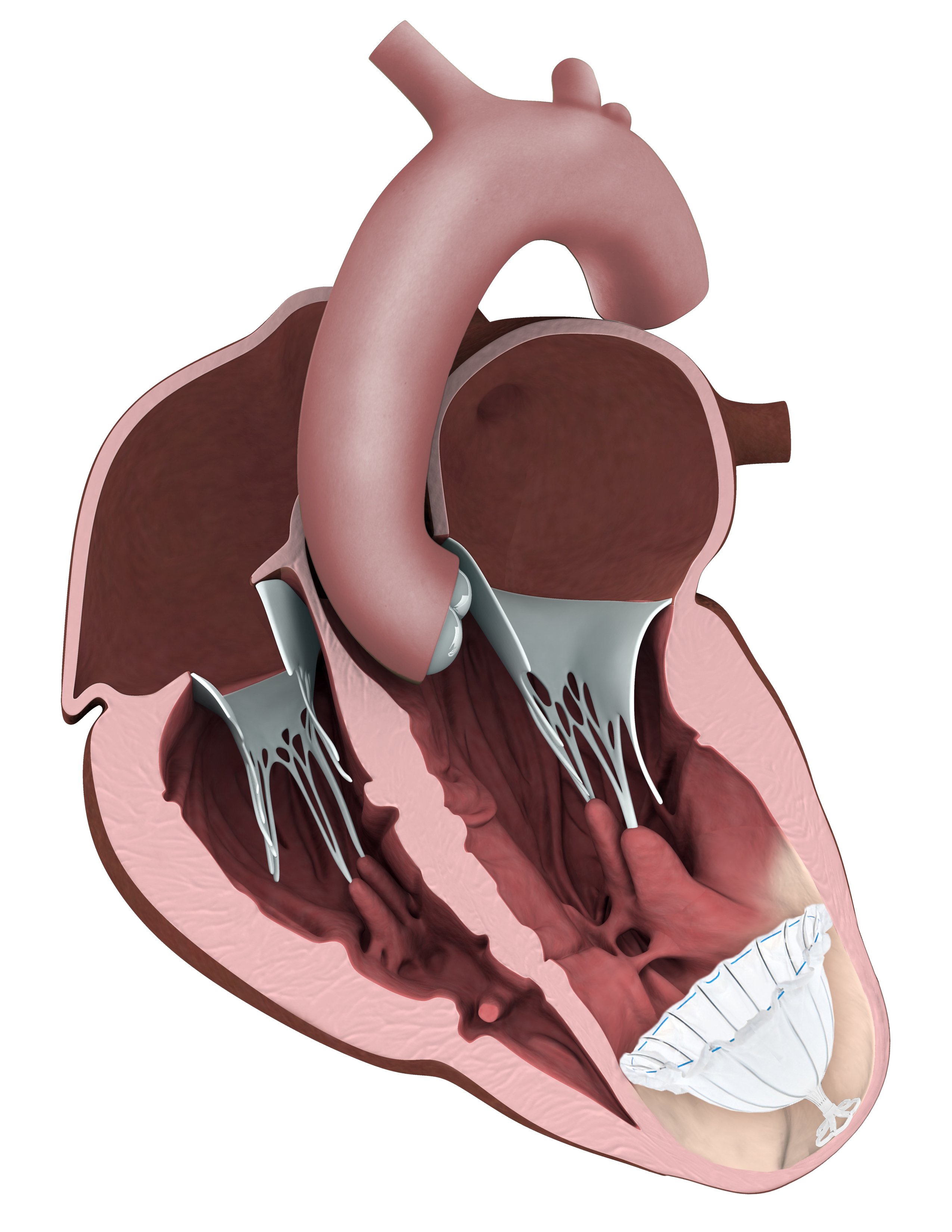 Heart failure: New electric mesh device gives the heart an