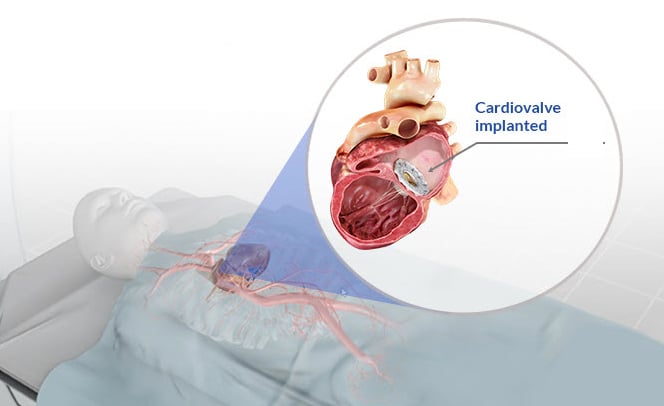 Technology Incubator Peregrine Ventures Exits Transcatheter Valve 