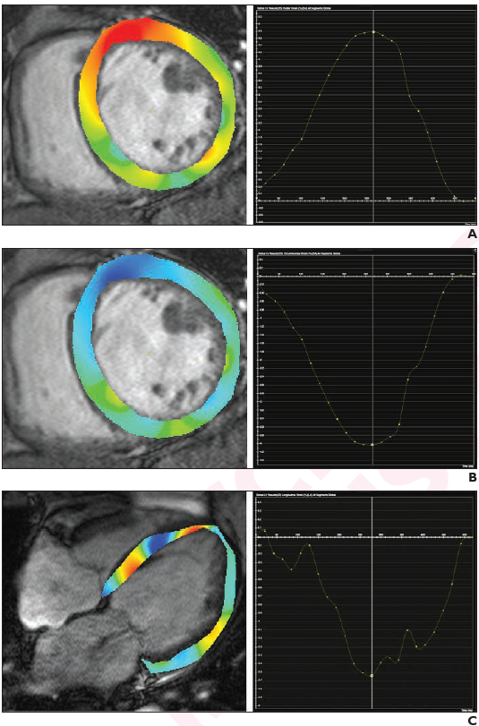 Clinical applications of feature-tracking cardiac magnetic resonance imaging