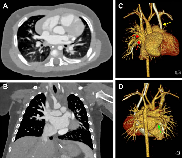 A three-dimensional 3-D chest computed tomography scan on the 17th