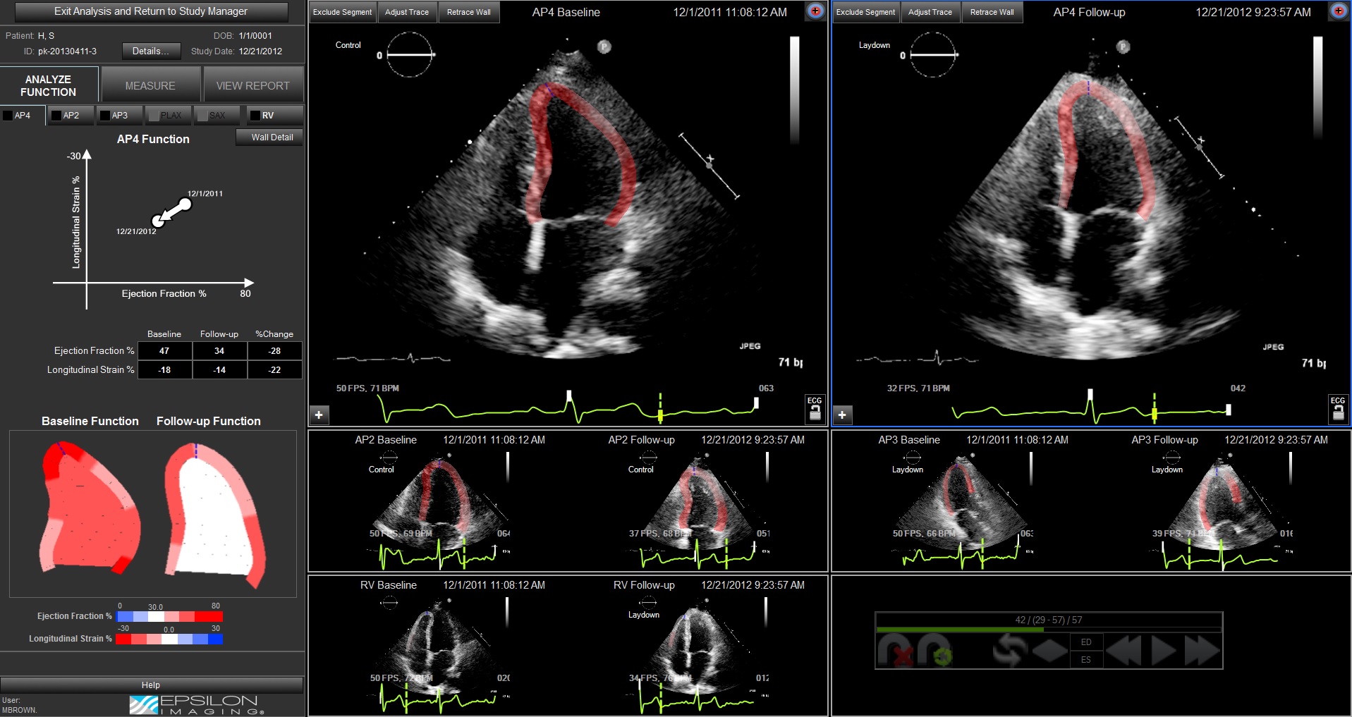 Global longitudinal strain assessment in contrast-enhanced echocardiography  in breast cancer patients: a feasibility study, Cardiovascular Ultrasound