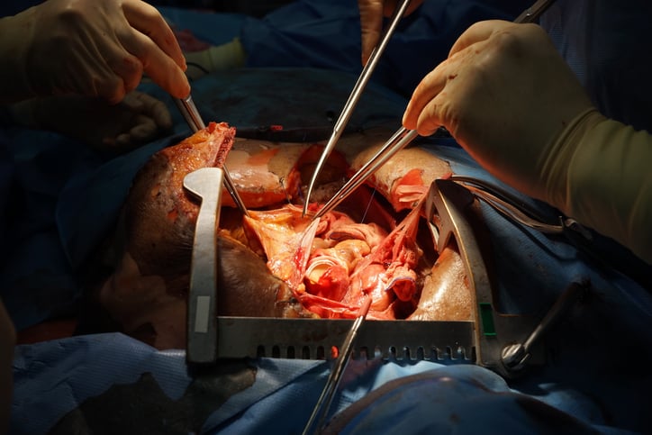 Rethinking Heart Surgery Surgical Site Infection Prevention