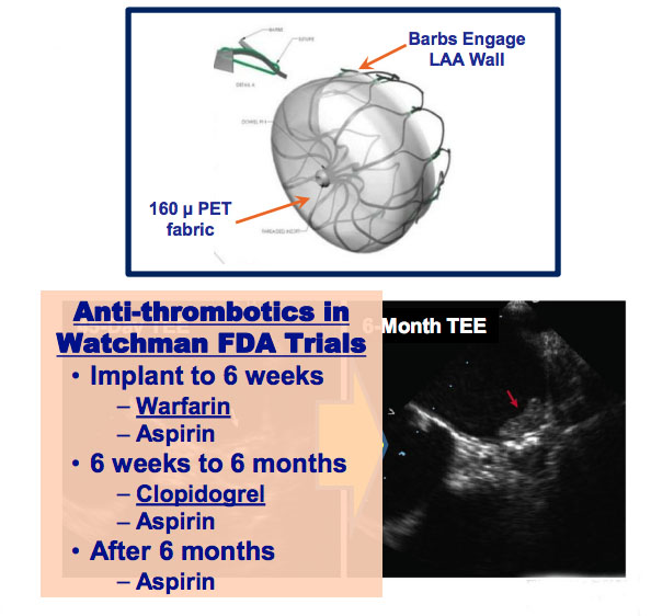 Predictors of Device-Related Thrombus Following Percutaneous Left