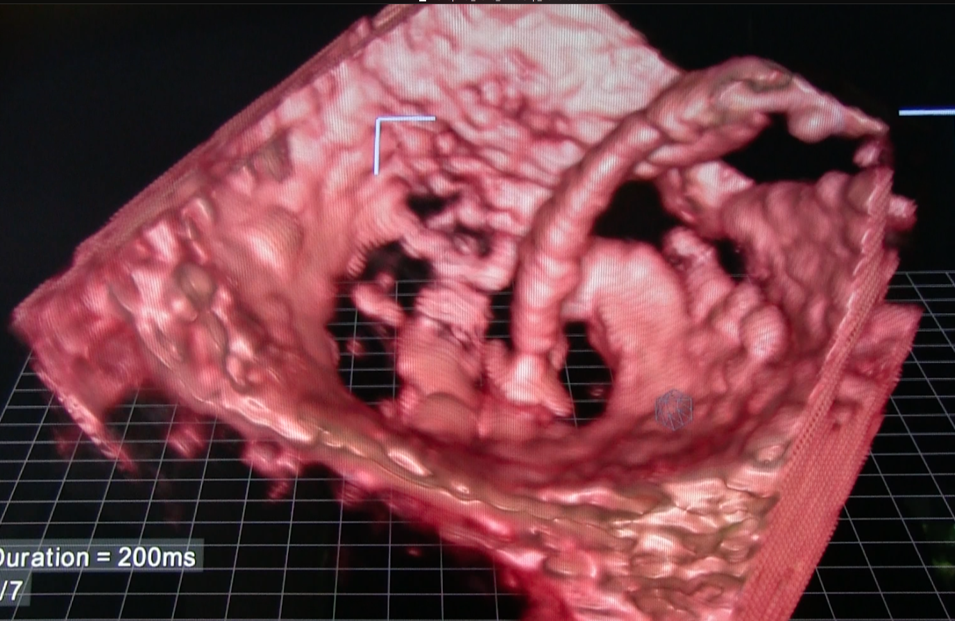 Virtual TEE: Standard Views, Cardiac, Transesophageal Echocardiography, 3D  Heart Model, Education