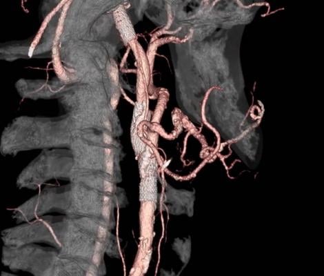 New Algorithm Expands Neurologists' Ability to Assess for Clot-removing Procedure