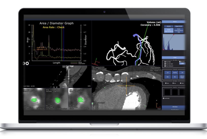 Ai Fully Automates Cardiac Ct Image 3 D Analysis Daic