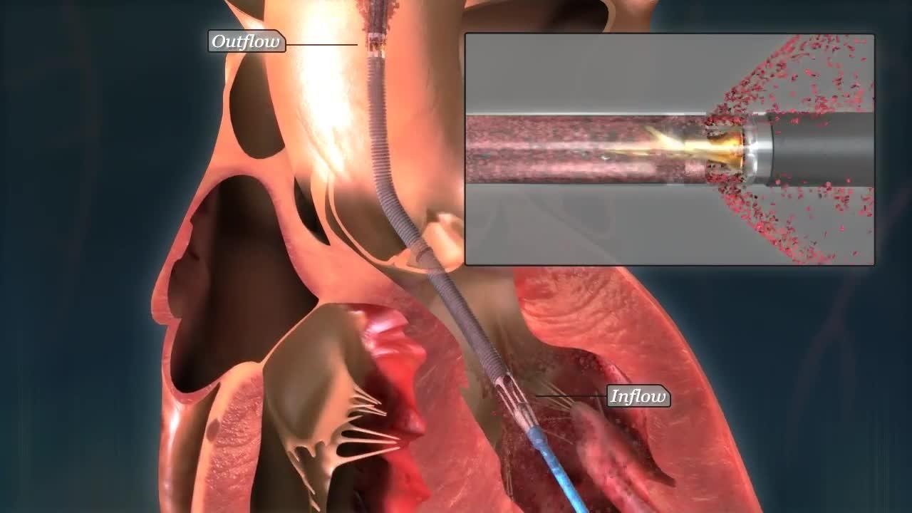 Video Demonstration Of The Impella Percutaneous Hemodynamic Support Device Daic