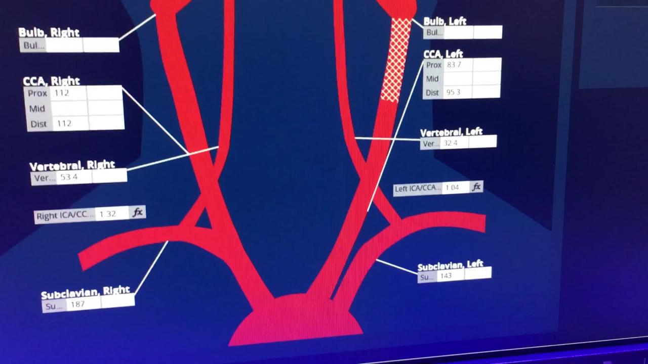 VIDEO: Carotid Artery Reporting Template Example | DAIC