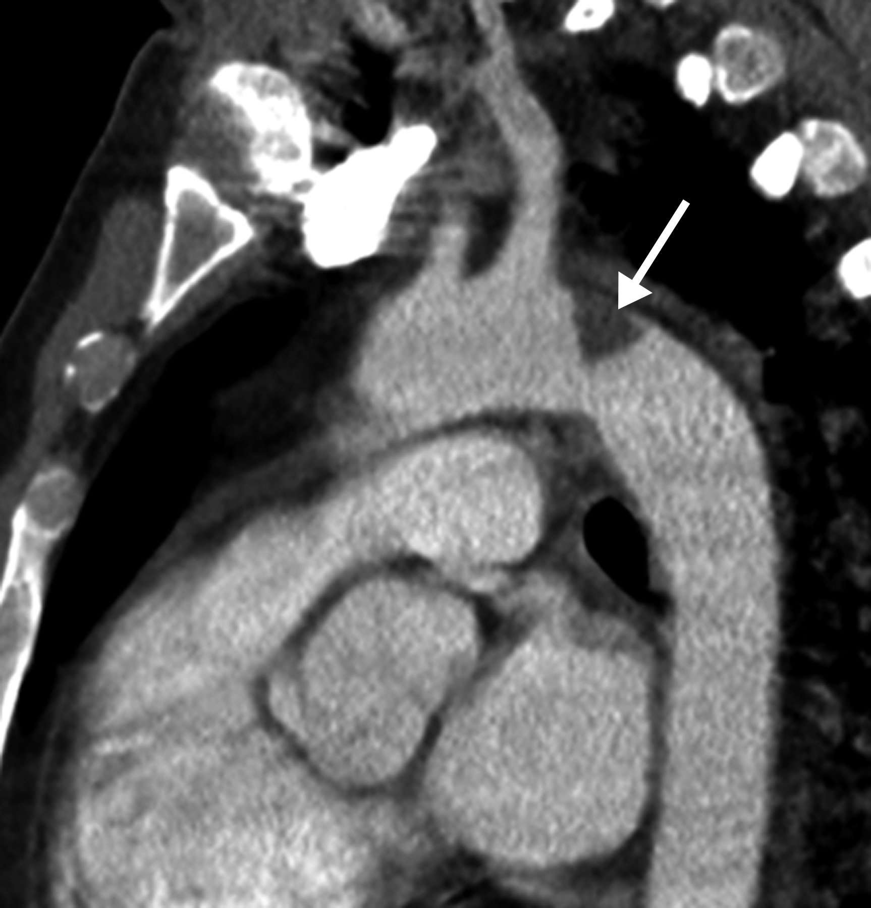 Nih Pauses Anticoagulant Trial For Critically Ill Covid 19 Patients Daic