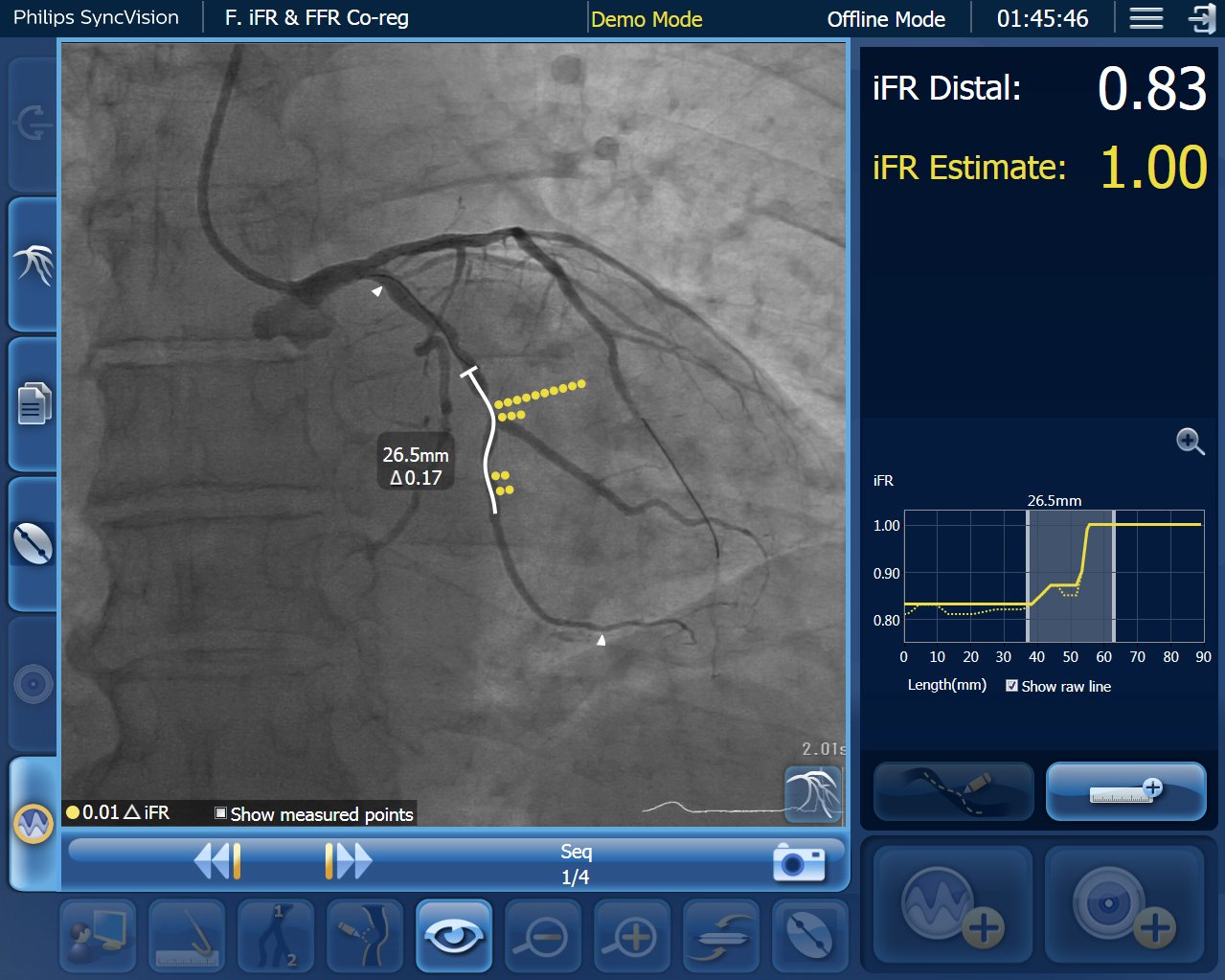 Define Pci Study One Year Data Show Potential Of Treating Residual Ischemia To Improve Outcomes For Coronary Stenting Daic