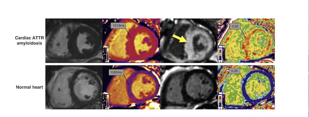 Emerging Novel Cardiac MR Imaging Biomarkers in Cardio-Vascular Rare Disease Clinical Trials