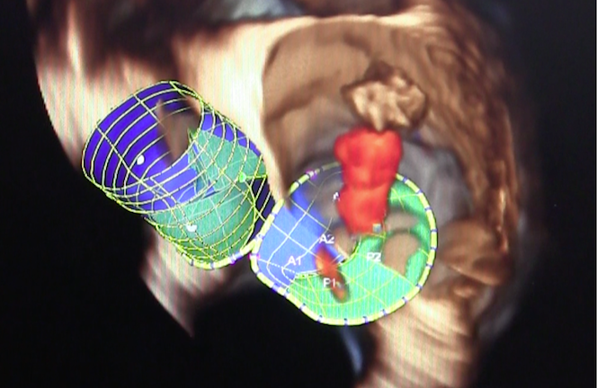 Minneapolis Heart Institute Foundation, TMVR, Tendyne, FDA, first implant, U.S.