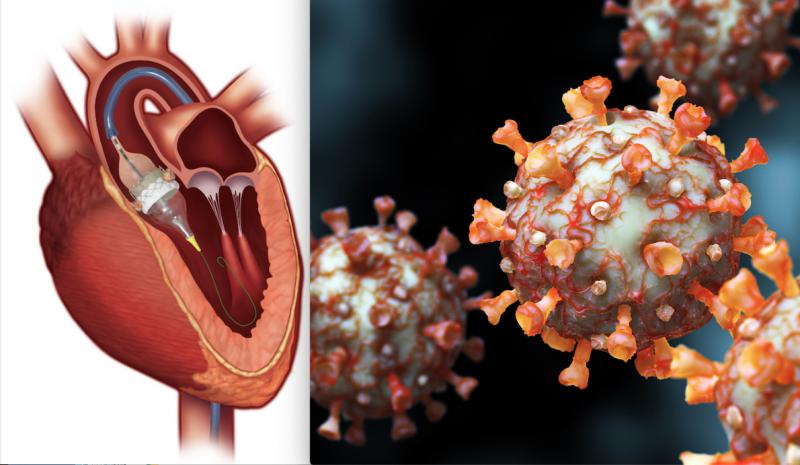 The ACC and SCAI created a guidance document to help triage structural heart patients to determine which need procedures during the COVID-19 pandemic and which can be postponed until later in the year. #COVID19 #coronavirus #SARScov2