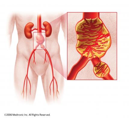 New Study Confirms More Unfavorable Outcomes for Women Than Men After AAA Repair  DAIC