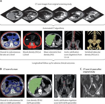 Schematic depiction of the automated process for assessing fat, muscle, liver, aortic calcification, and bone from original abdominal CT scan data