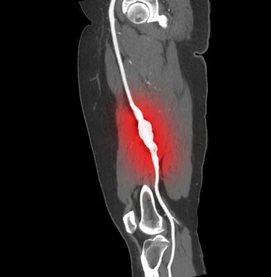Study finds statin use associated with improved limb salvage after intervention for peripheral artery disease