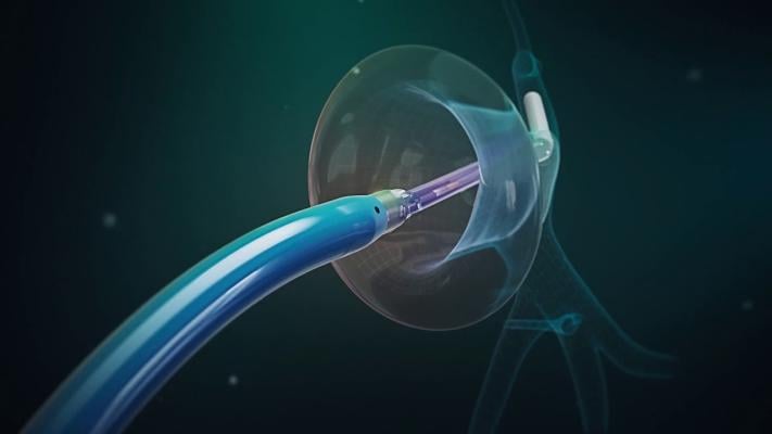 CardioFocus will feature its portfolio of innovative ablation systems which optimize lesion creation via confirmed tissue contact and sophisticated energy delivery