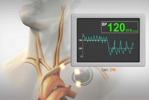 pacemaker blood pressure arm