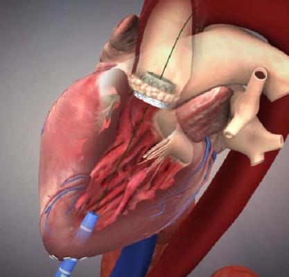 Edwards Sapien 3 Transcatheter Aortic Hear Valve Clinical Trial