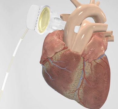 Collaboration Aims To Commercializing Transcutaneous Energy Transfer System To Power Vads Daic