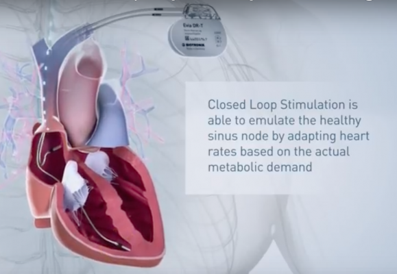 Closed Loop Stimulation Pacemaker Programing Reduces Syncope DAIC