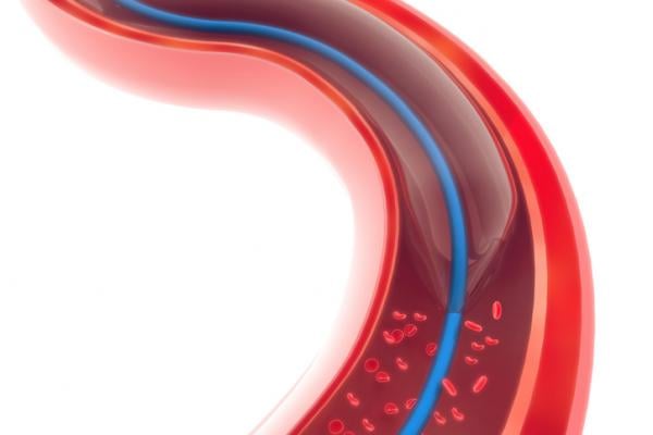 Overview of Angioplasty Balloon Technology Advances