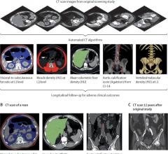 Schematic depiction of the automated process for assessing fat, muscle, liver, aortic calcification, and bone from original abdominal CT scan data