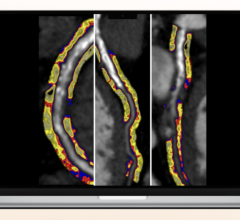 Caristo Diagnostics Limited has announced the results of a landmark clinical study published in The Lancet that support the ability of Caristo's CaRi-Heart AI technology to quantify coronary artery inflammation and accurately predict cardiac events.
