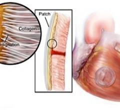 Gecko Biomedical cardiovascular surgery structural heart adhesive