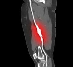 Study finds statin use associated with improved limb salvage after intervention for peripheral artery disease