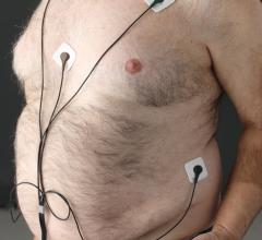 The prevalences of atrial fibrillation (AF) and obesity continue to increase in parallel
