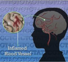 NIH Cardiac Diagnostics Genetic Disorder Strokes Vascular Inflammation Children