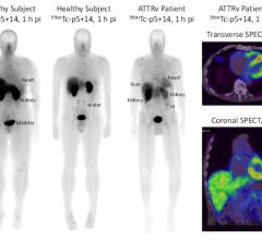 A newly developed radiotracer can generate high quality and readily interpretable images of cardiac amyloidosis