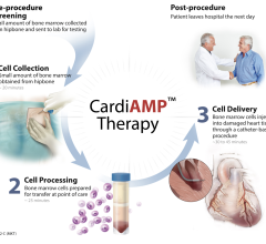 BioCardia, Inc., a global leader in cellular and cell-derived therapeutics for the treatment of cardiovascular and pulmonary diseases, announced today that the confirmatory Phase 3 trial of its autologous CardiAMP cell therapy product candidate for patients with ischemic heart failure of reduced ejection fraction (HFrEF) has commenced enrollment in the United States