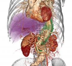 aortic dissection, family history, same age, clinical study, John A. Elefteriades, Annals of Thoracic Surgery