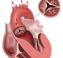 aortic stenosis, Canadian Cardiovascular Conference, LDL-C