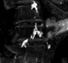 Heavy calcification around the Aortic bifurcation in a 3,000 year old mummy.