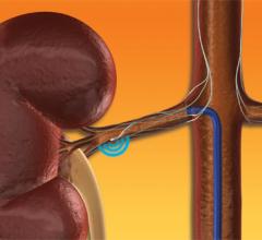 Medtronic, symplicity, renal denervation