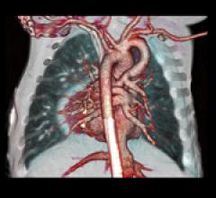 CT angiography, comparing CT systems, what to look for in CT systems