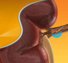 renal denervation clinical trial study hypertension cath medtronic symplicity