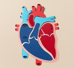 Emboline Emboline Completes Enrollment in U.S. Pivotal IDE Trial of Embolic Protection Catheter