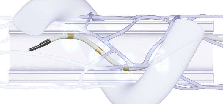 Medtronic Hybrid Ablation